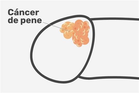 causas del cáncer de pene